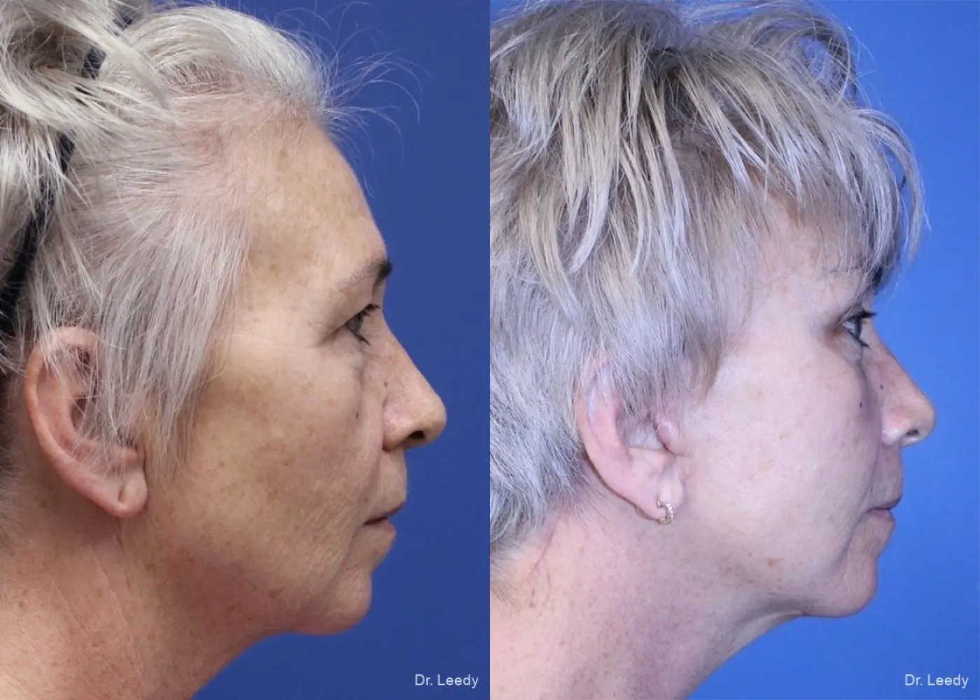 Lower Blepharoplasty: Patient 3 - Before and After 3