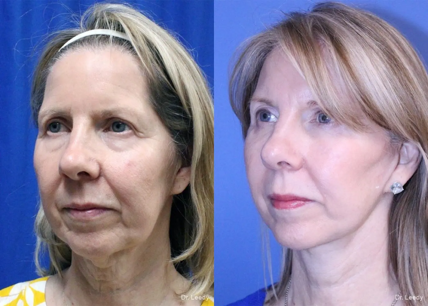 Lower Blepharoplasty: Patient 4 - Before and After 4