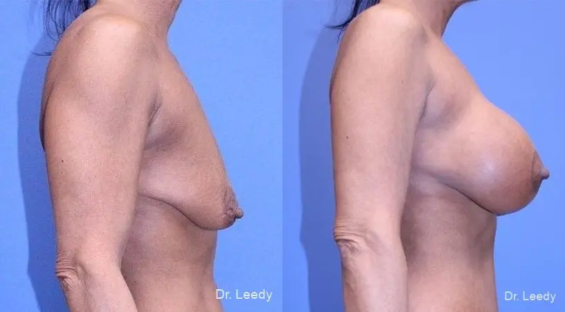 Mastopexy-Augmentation: Patient 1 - Before and After 3