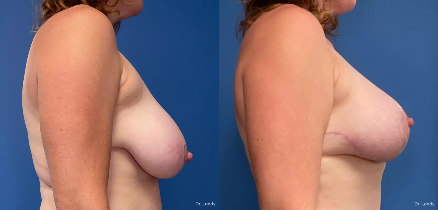 Mastopexy-Augmentation: Patient 2 - Before and After 3