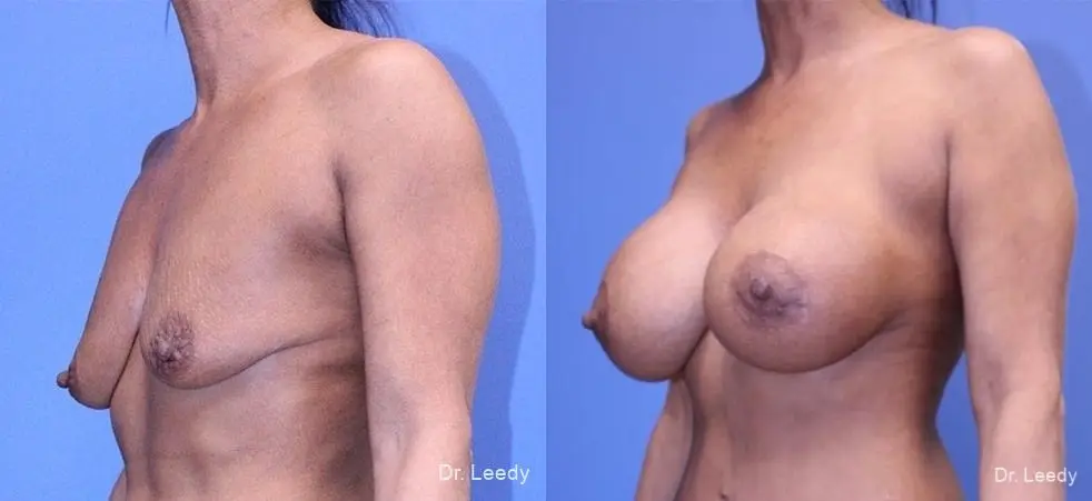 Mastopexy-Augmentation: Patient 1 - Before and After 4
