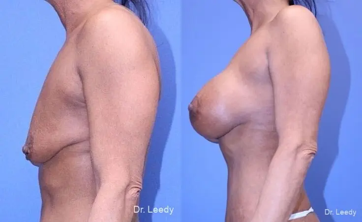 Mastopexy-Augmentation: Patient 1 - Before and After 5