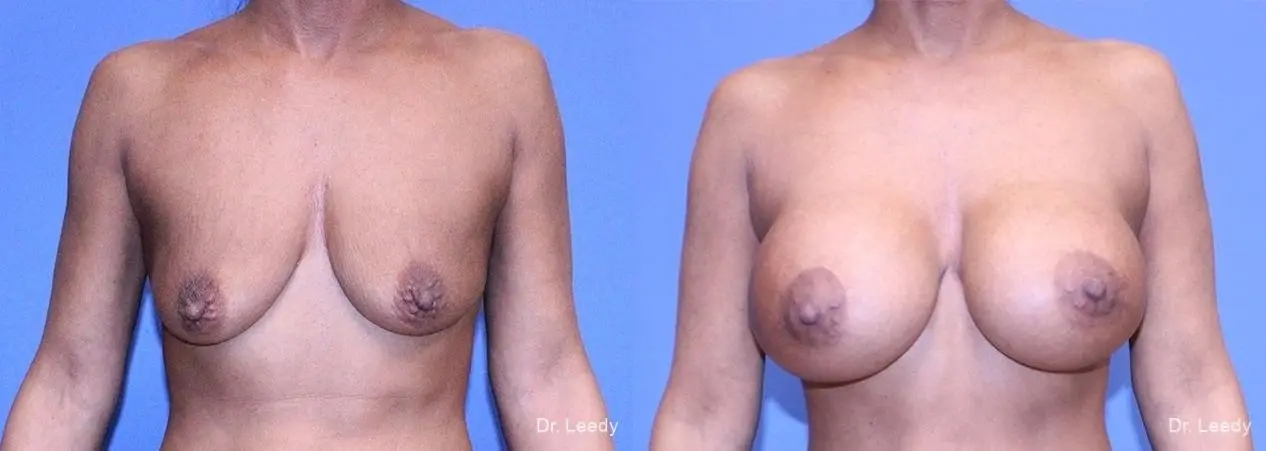 Mastopexy-Augmentation: Patient 1 - Before and After  