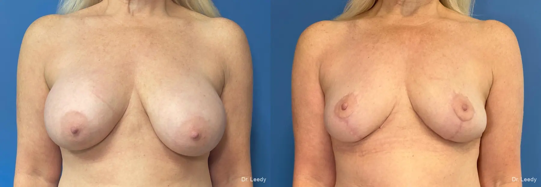 Mastopexy: Patient 5 - Before and After  