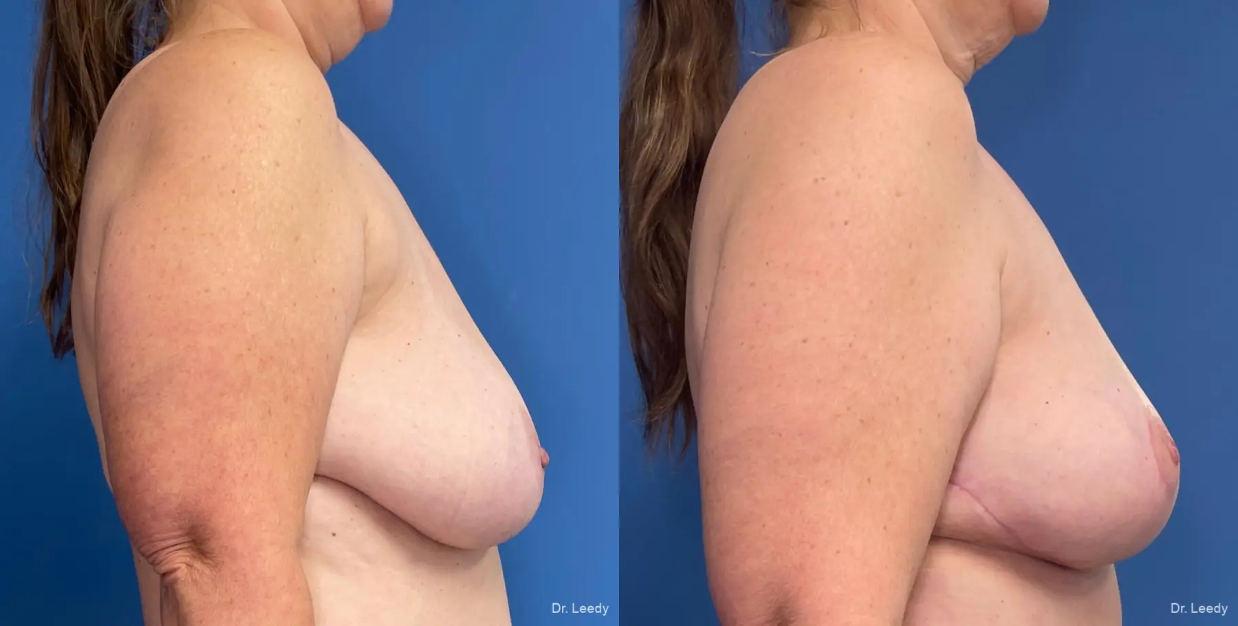 Mastopexy: Patient 4 - Before and After 3