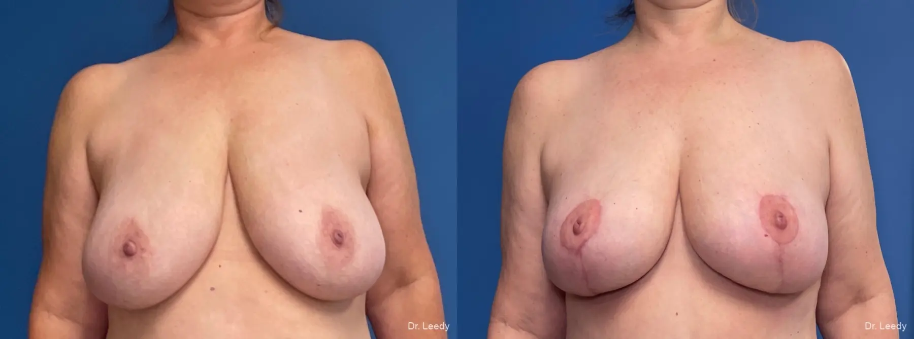 Mastopexy: Patient 4 - Before and After  