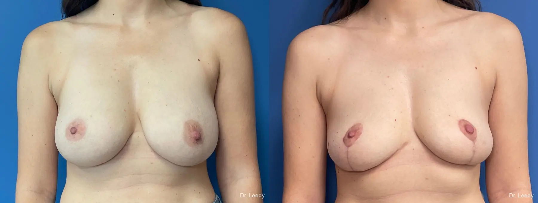 Mastopexy: Patient 3 - Before and After  