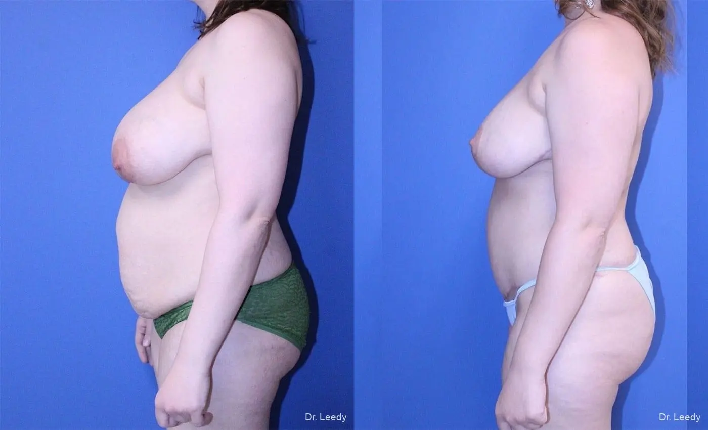 Mastopexy: Patient 1 - Before and After 5