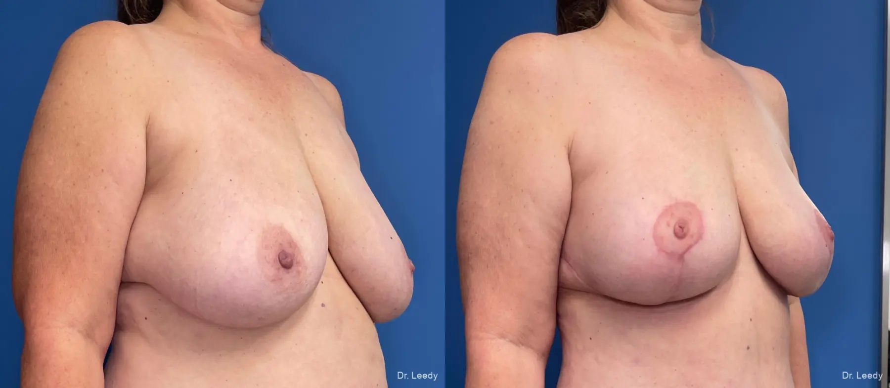 Mastopexy: Patient 4 - Before and After 2
