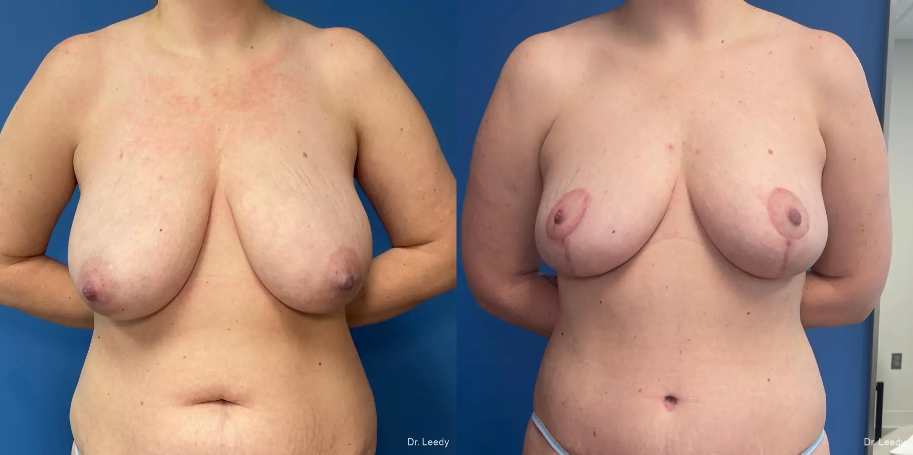Mastopexy: Patient 2 - Before and After  