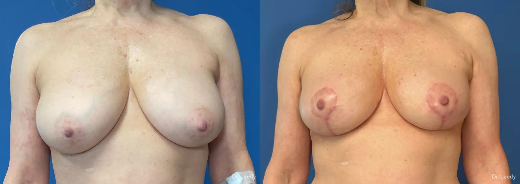 Mastopexy: Patient 8 - Before and After  