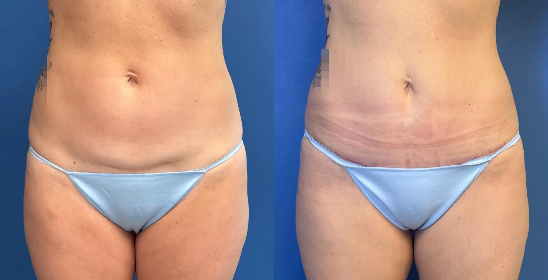 Mini Tummy Tuck: Patient 1 - Before and After  