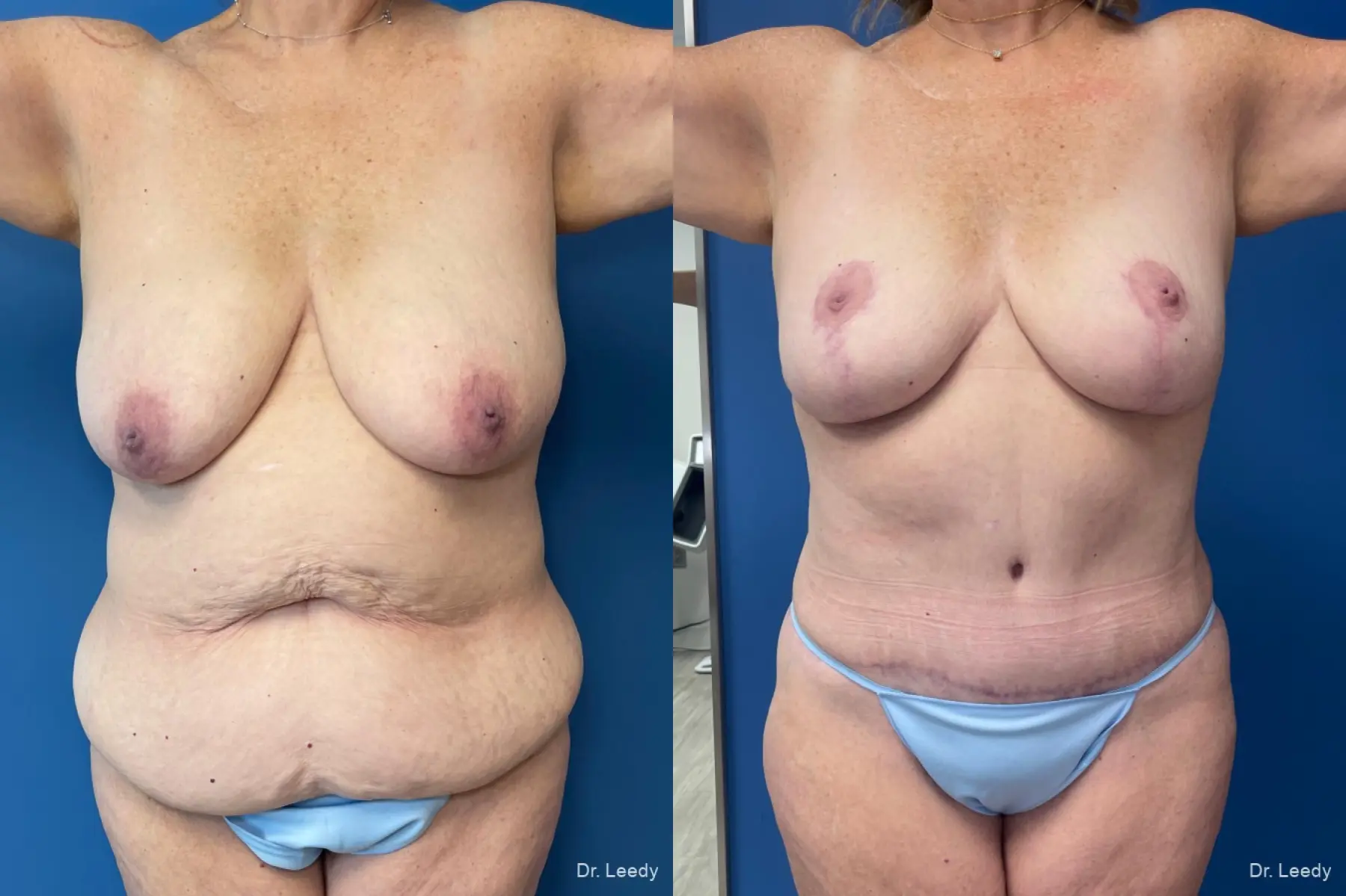 Mommy Makeover: Patient 10 - Before and After  