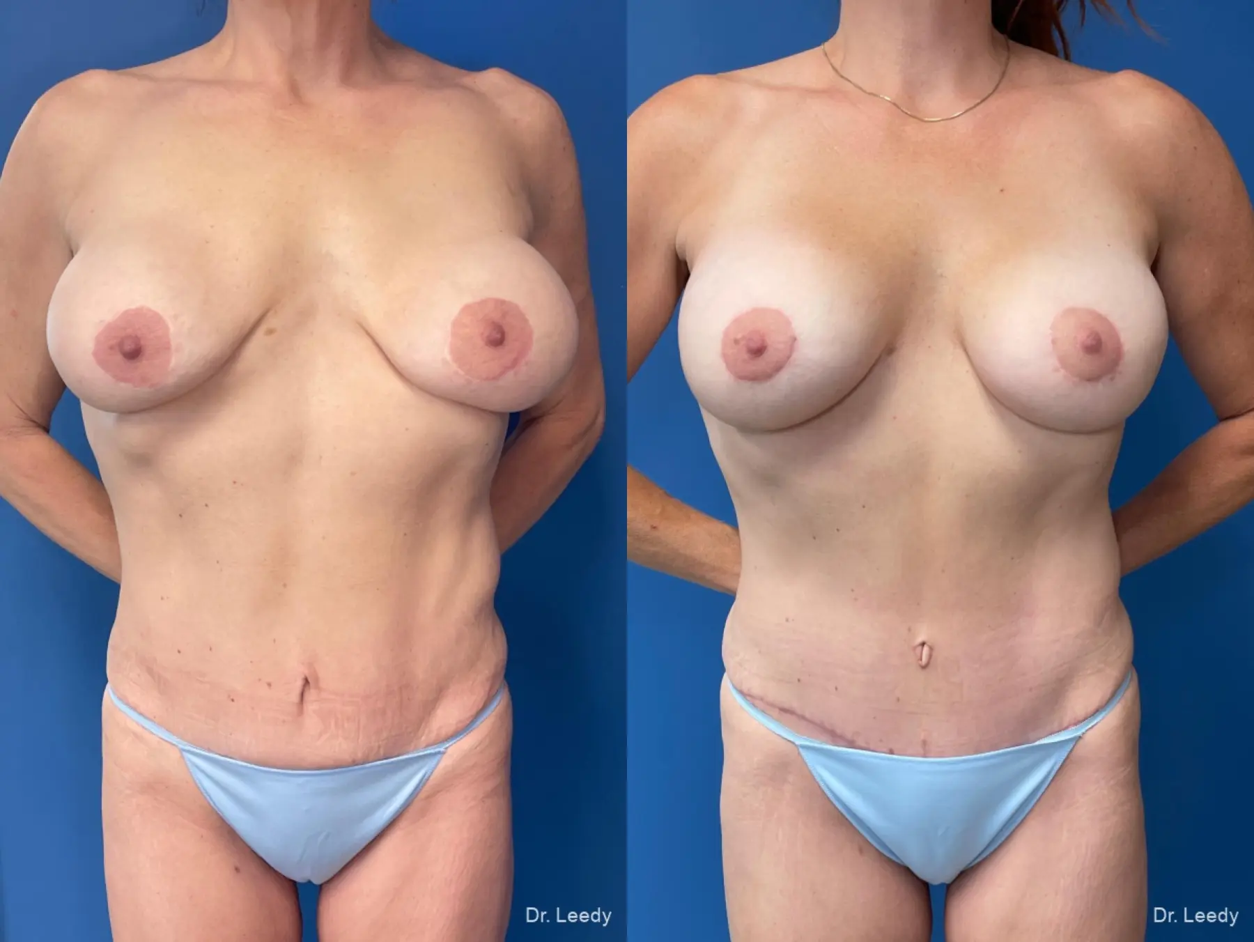Mommy Makeover: Patient 12 - Before and After  