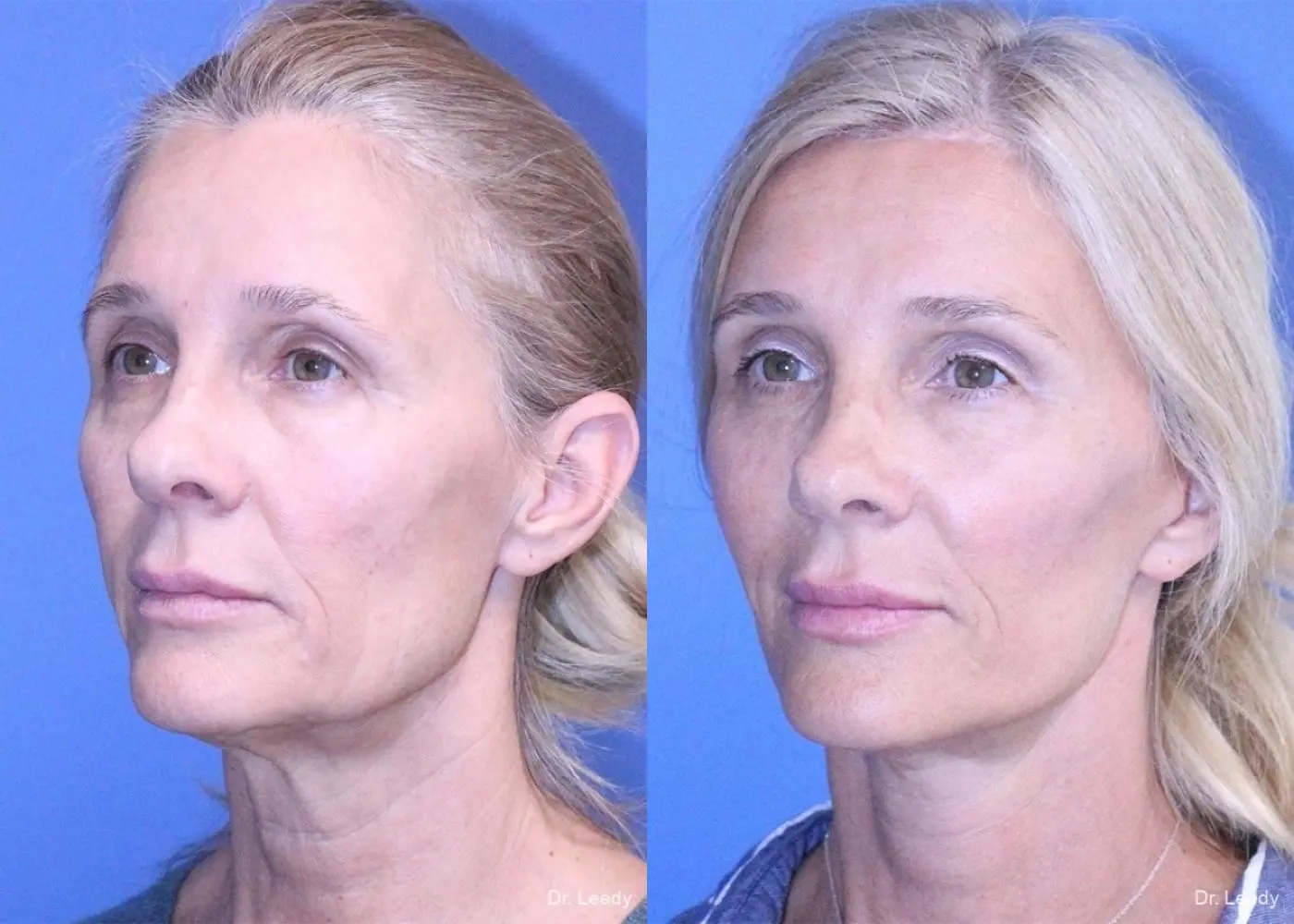 Neck Lift: Patient 2 - Before and After 4