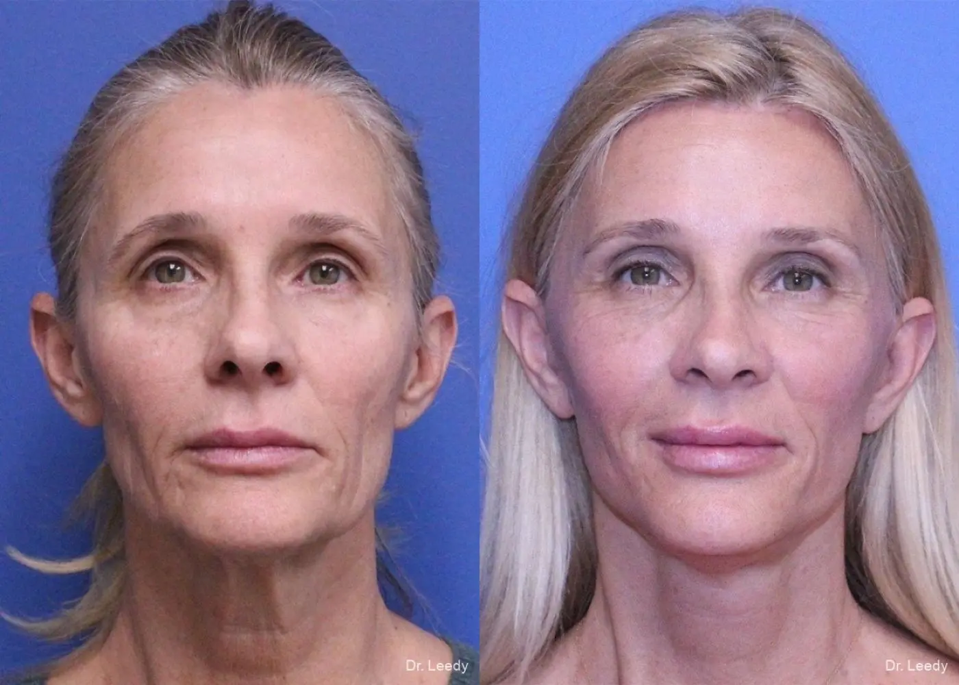 Neck Lift: Patient 2 - Before and After  