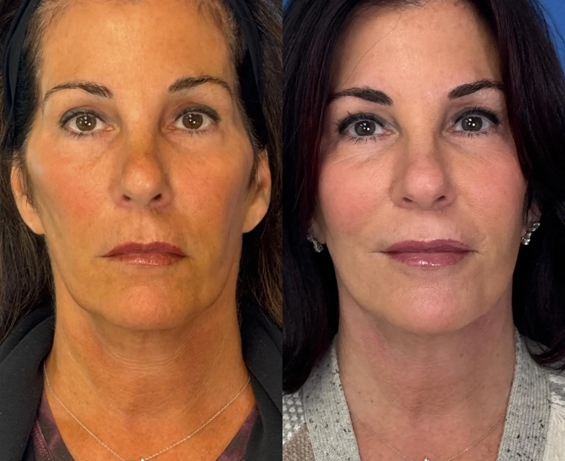Neck Lift: Patient 5 - Before and After  