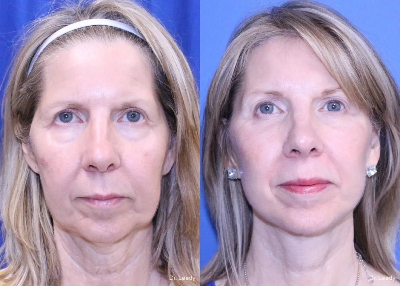 Neck Lift: Patient 4 - Before and After  