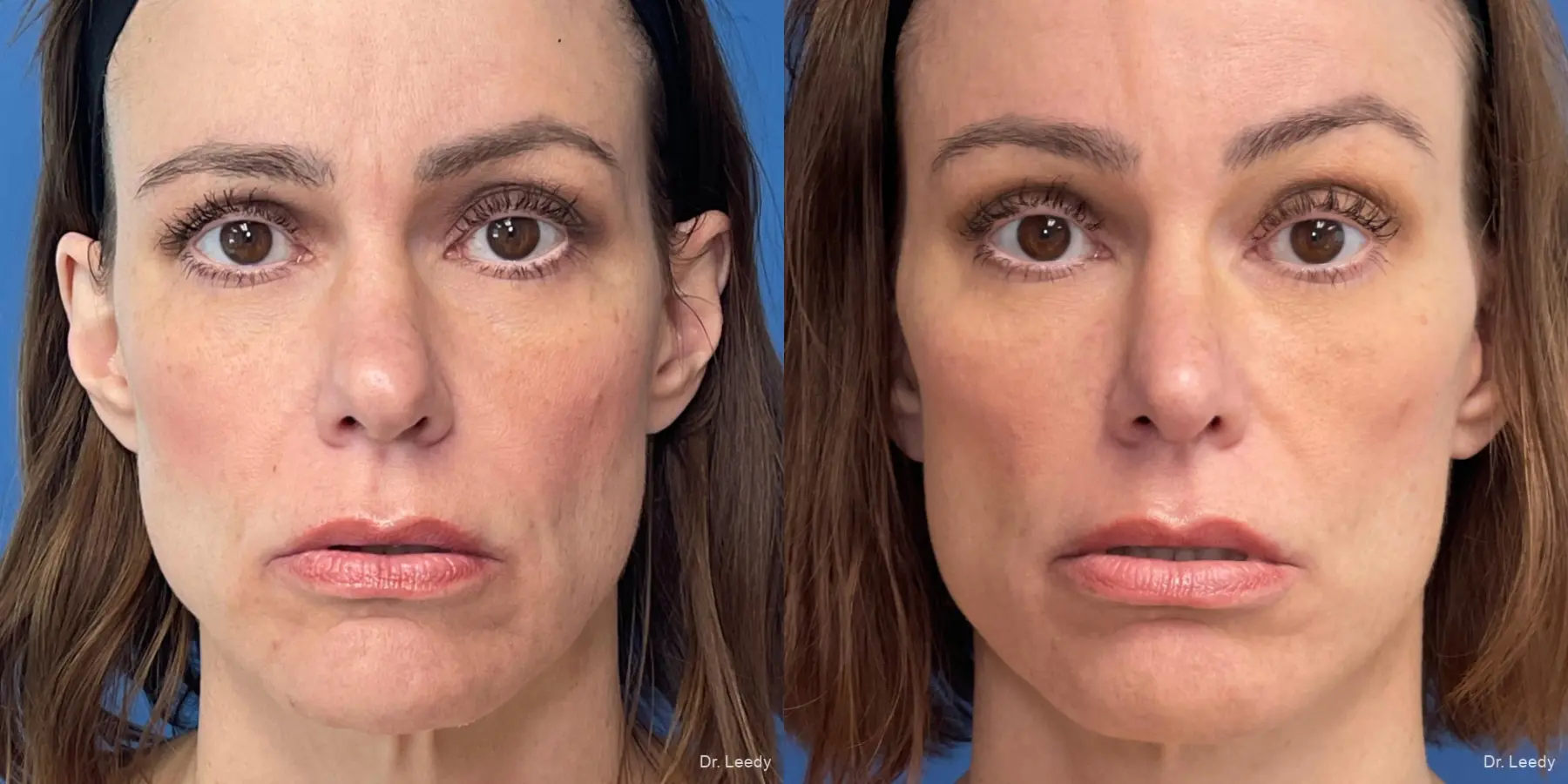 Rhinoplasty: Patient 2 - Before and After  