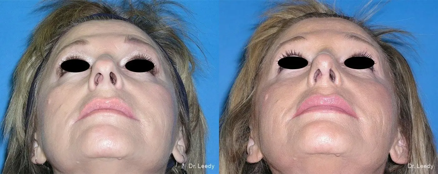 Rhinoplasty: Patient 3 - Before and After 6