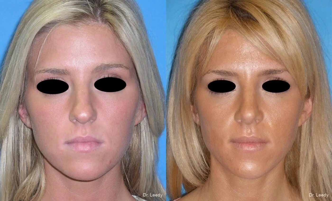 Rhinoplasty: Patient 6 - Before and After  