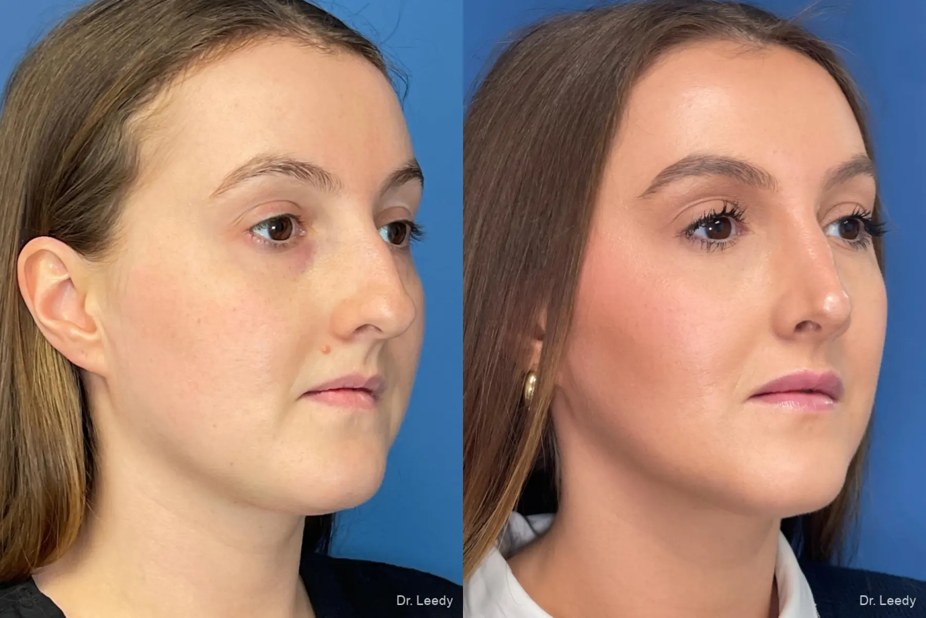 Rhinoplasty: Patient 1 - Before and After 2
