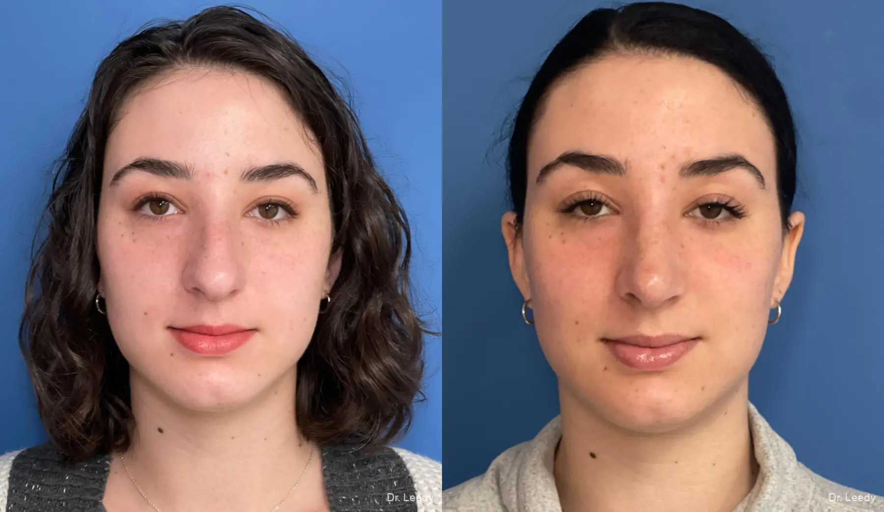 Rhinoplasty: Patient 8 - Before and After  