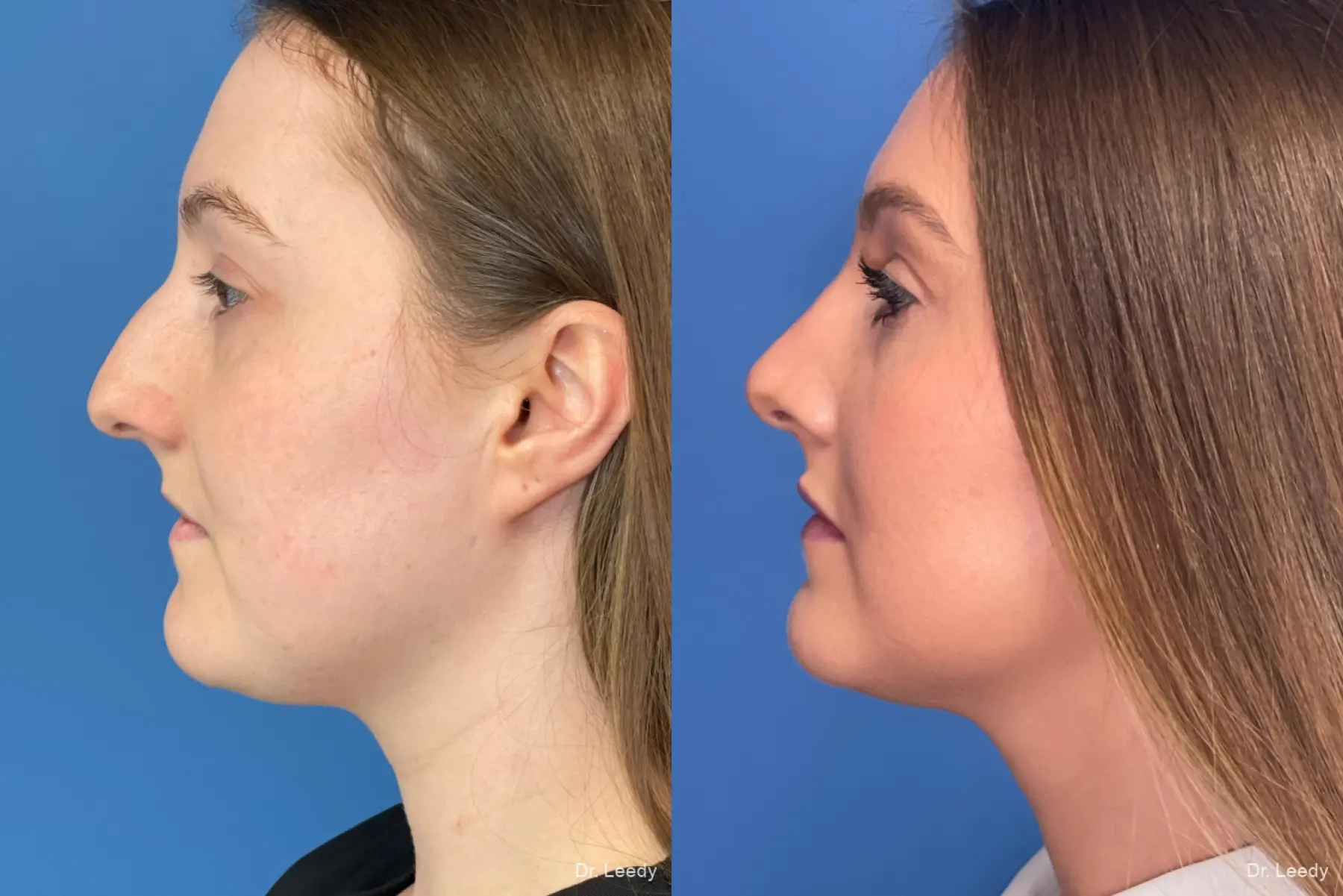 Rhinoplasty: Patient 1 - Before and After 5