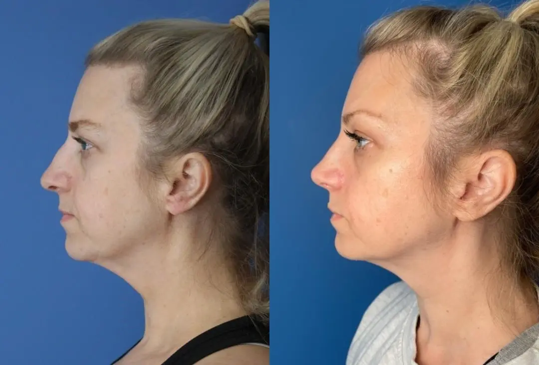 Rhinoplasty: Patient 3 - Before and After 3