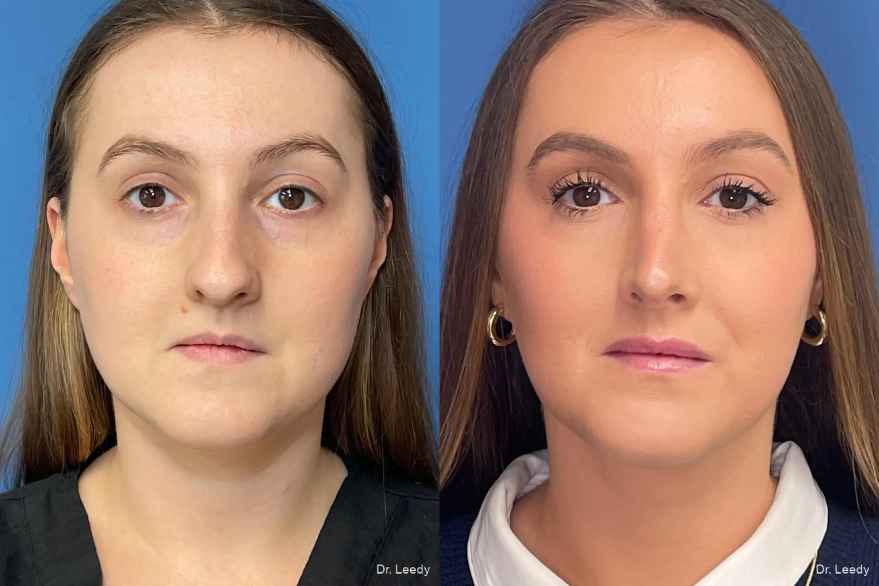 Rhinoplasty: Patient 1 - Before and After  