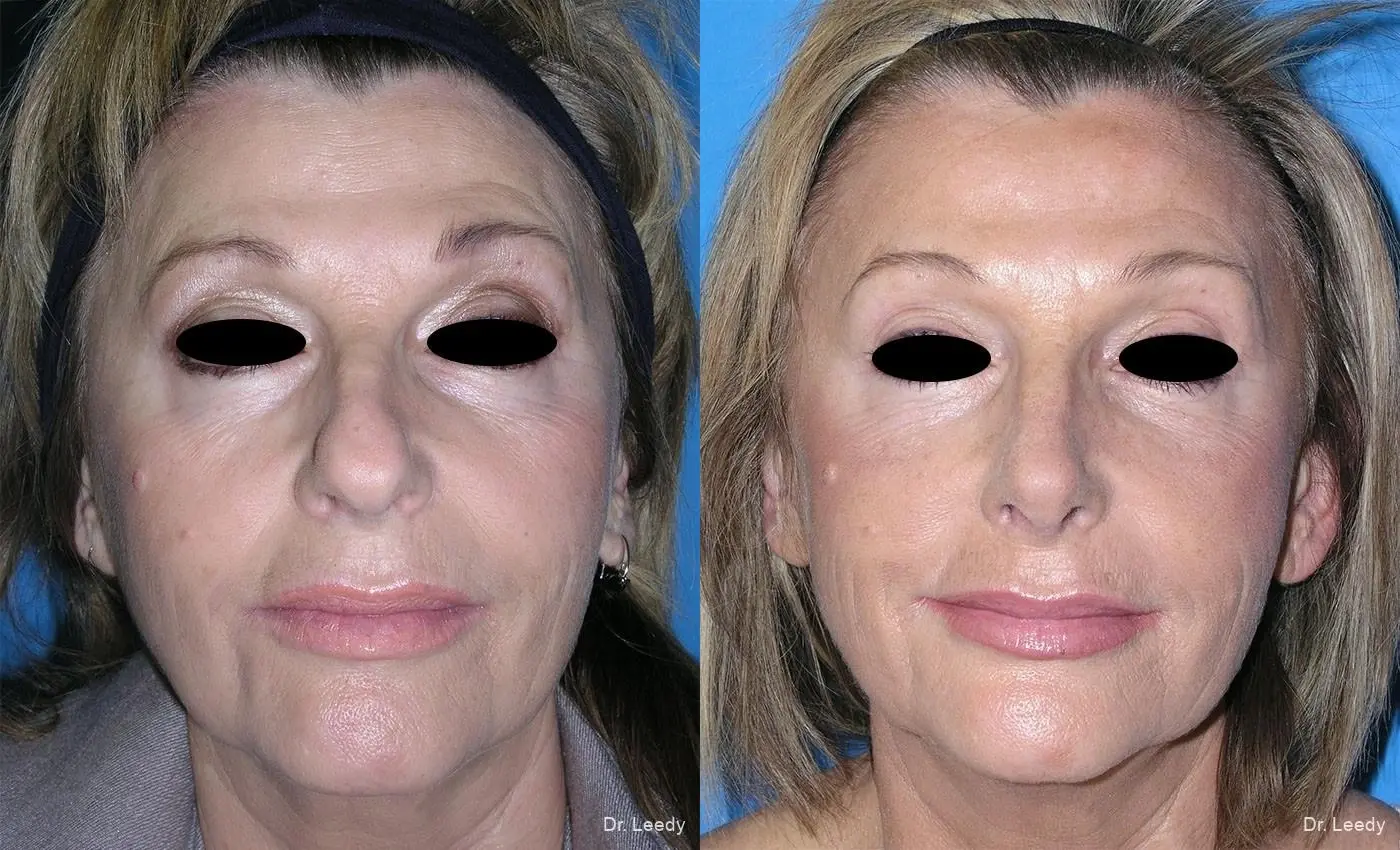 Rhinoplasty: Patient 5 - Before and After  