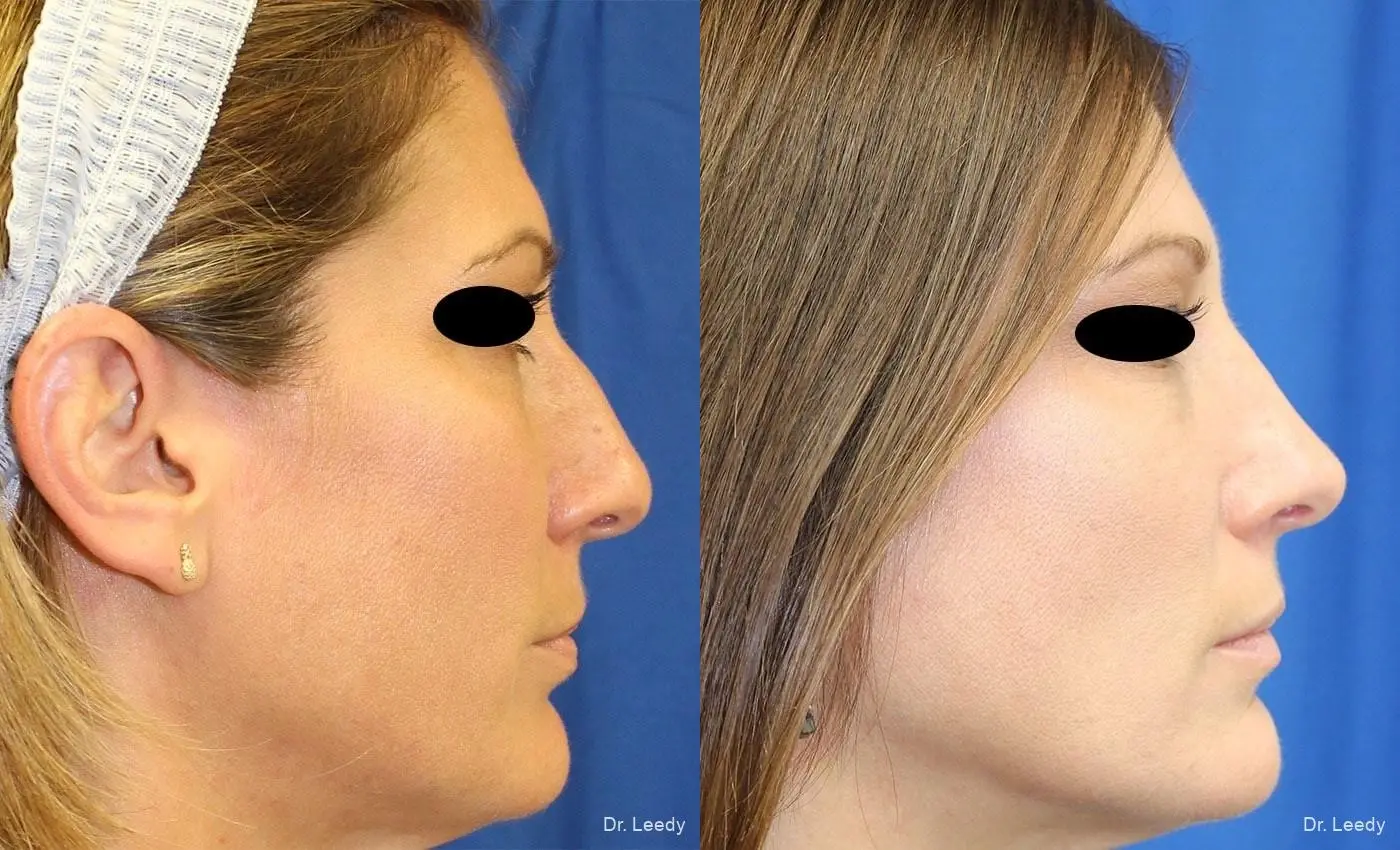Rhinoplasty: Patient 4 - Before and After 3