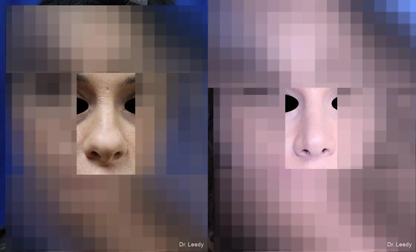 Rhinoplasty: Patient 1 - Before and After  