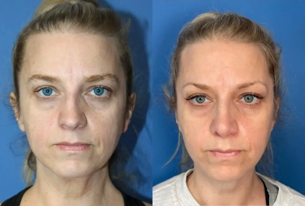 Rhinoplasty: Patient 3 - Before and After  