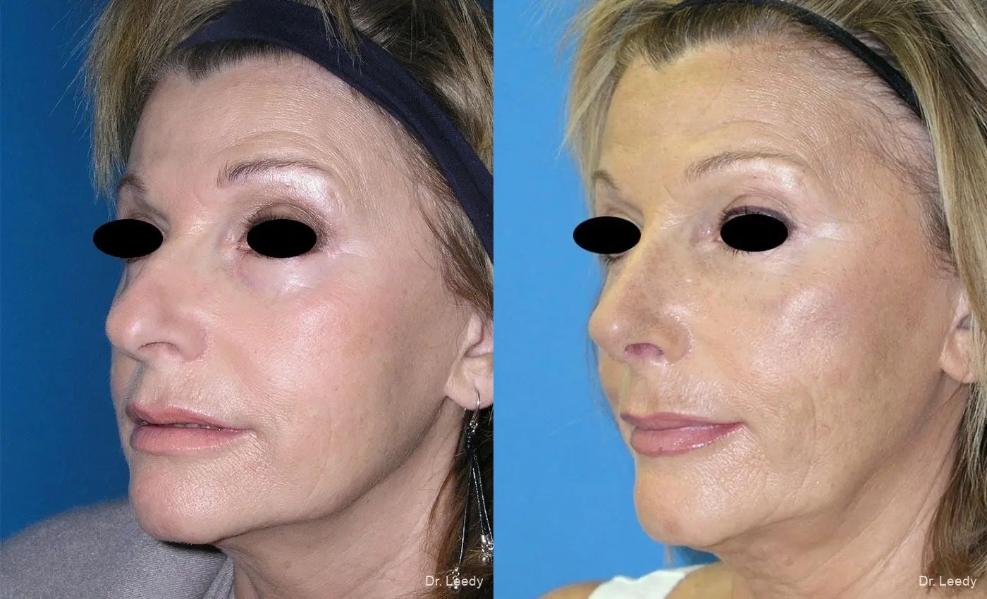 Rhinoplasty: Patient 5 - Before and After 4