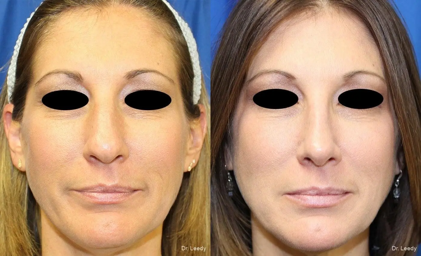 Rhinoplasty: Patient 4 - Before and After  