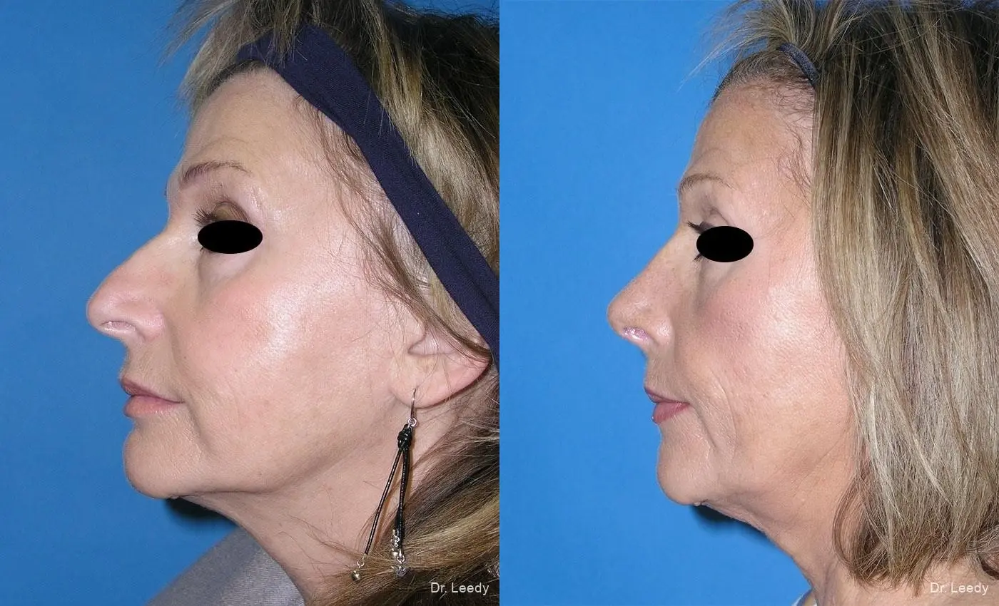 Rhinoplasty: Patient 3 - Before and After 5