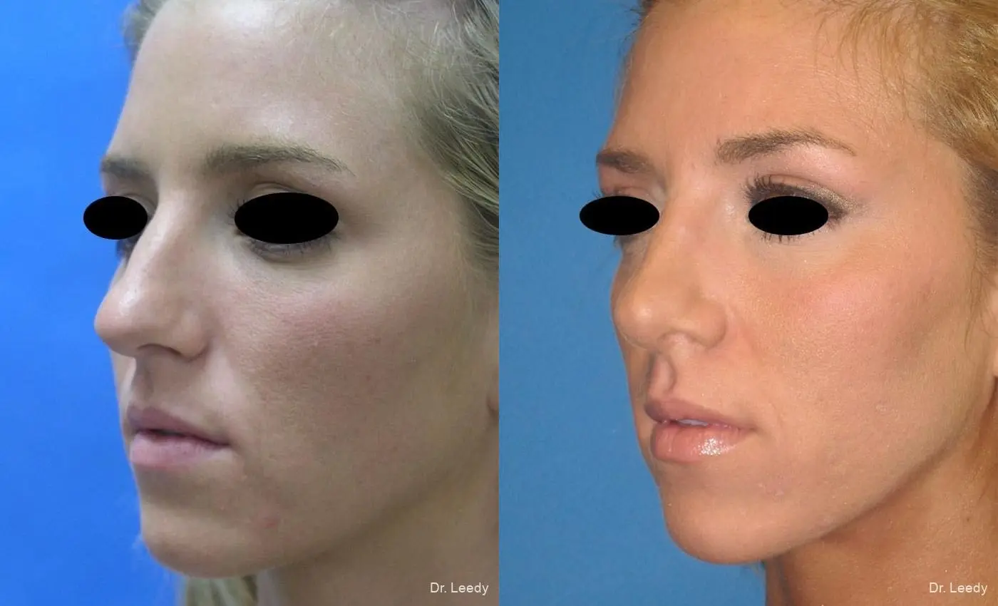 Rhinoplasty: Patient 4 - Before and After 4