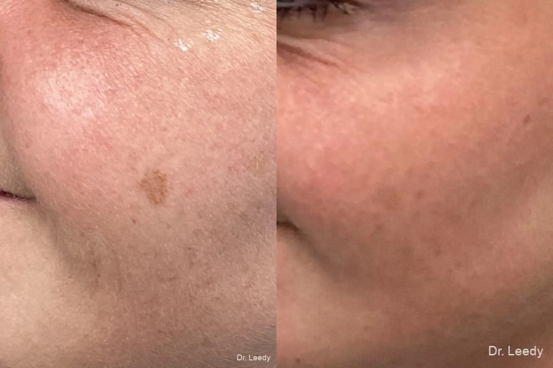 Skin Care Products: Patient 5 - Before and After  