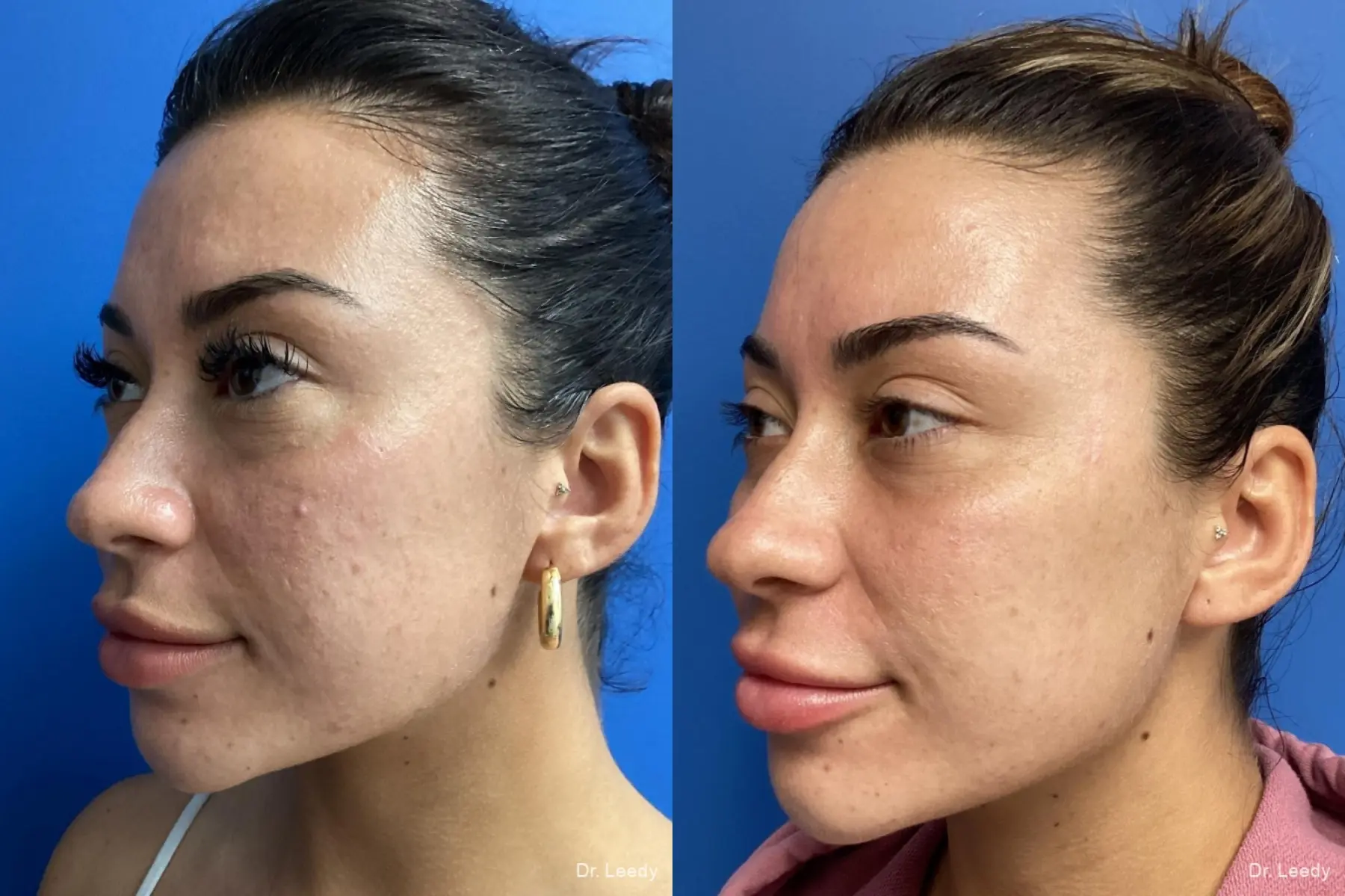 Skin Care Products: Patient 1 - Before and After 1