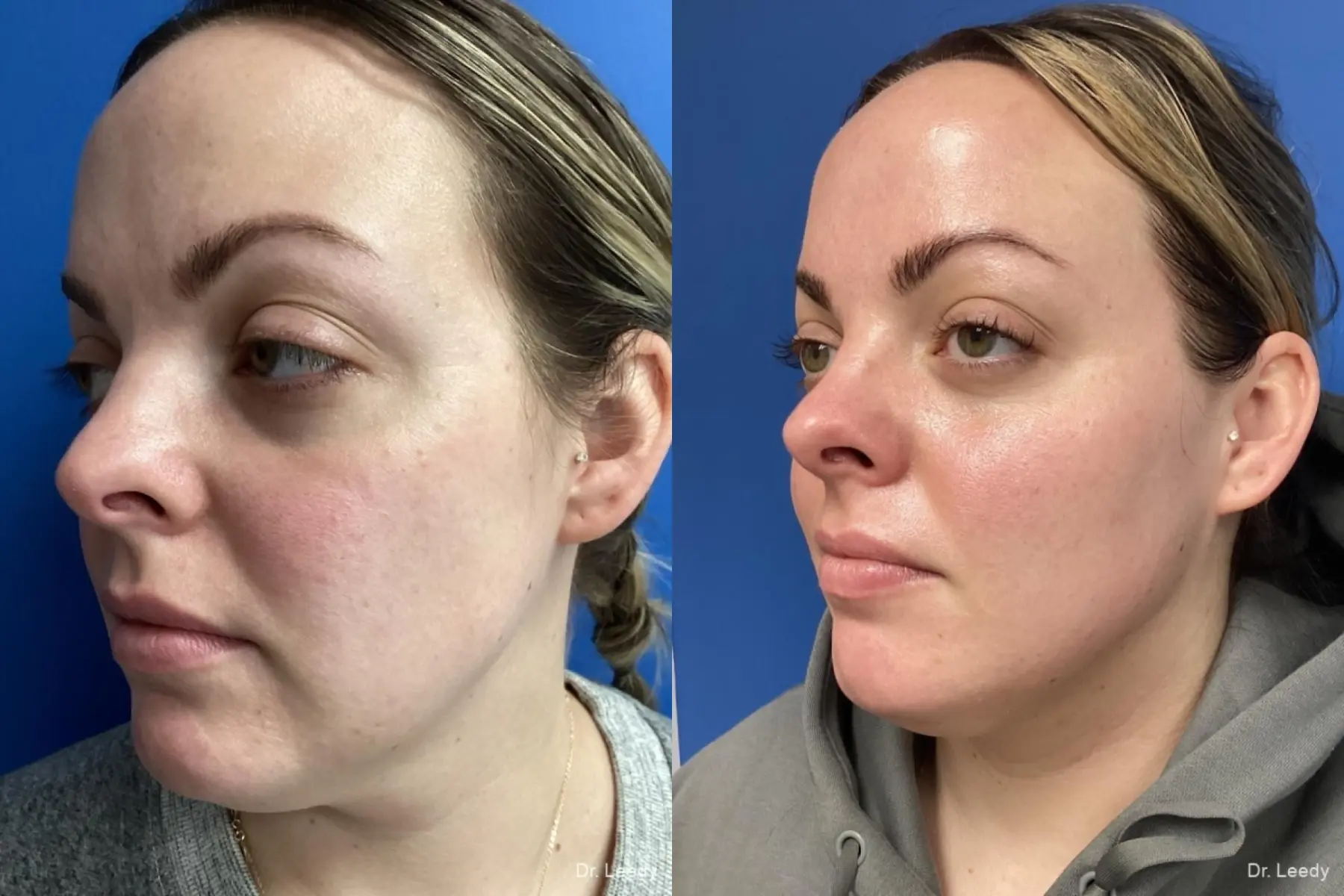 Skin Care Products: Patient 4 - Before and After  