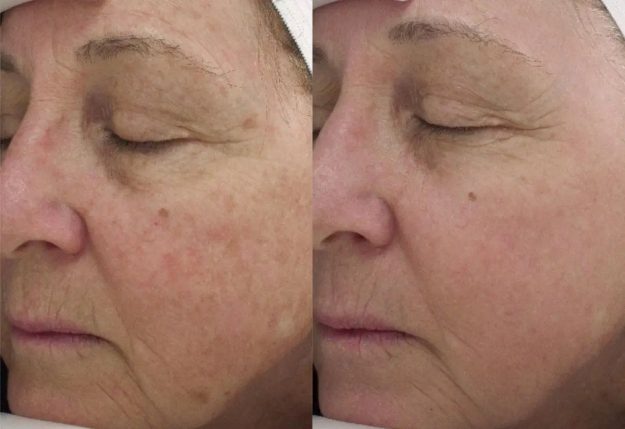 Skin Resurfacing: Patient 1 - Before and After  