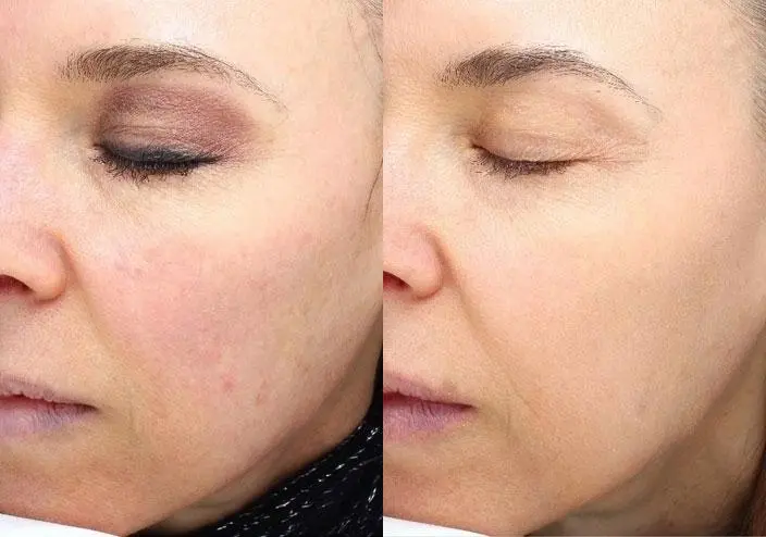 Skin Resurfacing: Patient 2 - Before and After  