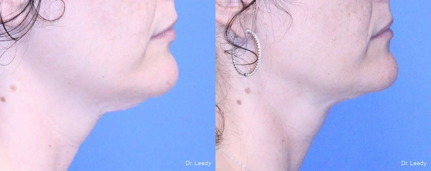 SmartLipo® - Chin: Patient 1 - Before and After 3