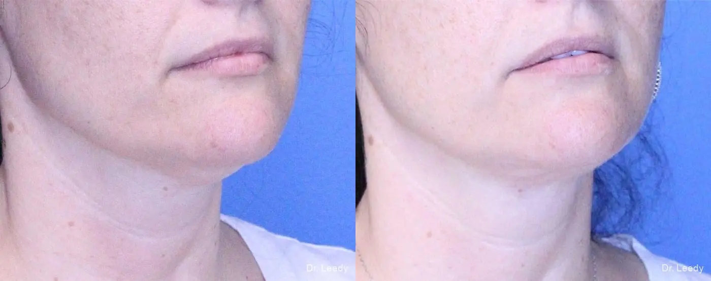 SmartLipo® - Chin: Patient 1 - Before and After 2