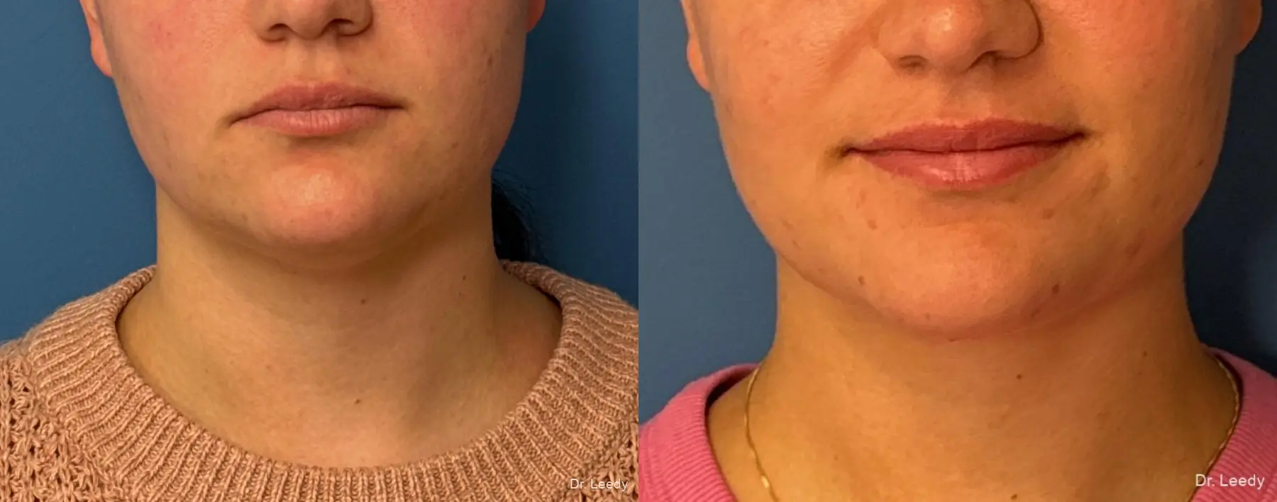 SmartLipo® - Chin: Patient 9 - Before and After  
