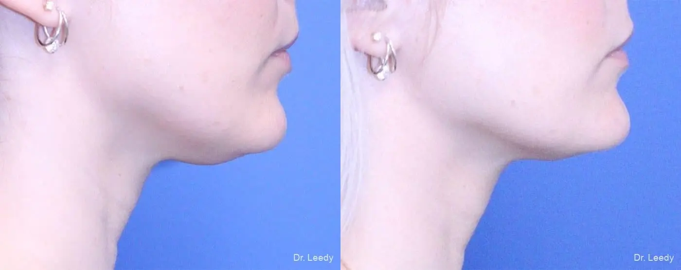 SmartLipo® - Chin: Patient 2 - Before and After 2