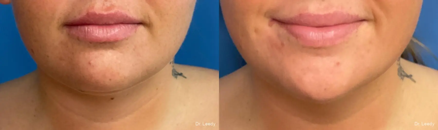 SmartLipo® - Chin: Patient 4 - Before and After  