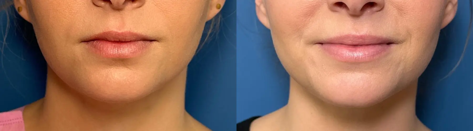 SmartLipo® - Chin: Patient 10 - Before and After
