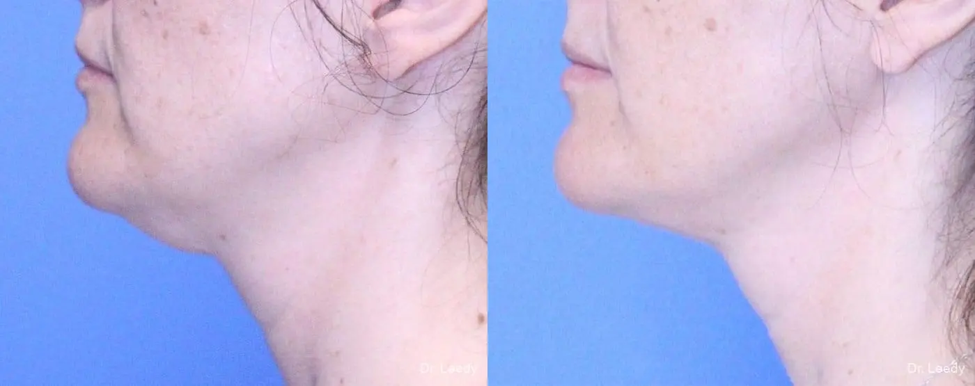 SmartLipo® - Chin: Patient 1 - Before and After 5